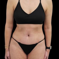 Tummy Tuck Before & After Patient #2694
