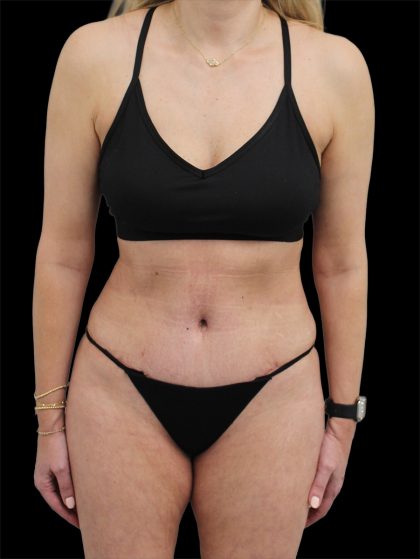 Tummy Tuck Before & After Patient #2694