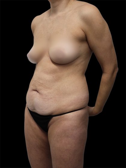 Tummy Tuck Before & After Patient #2694