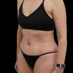 Tummy Tuck Before & After Patient #2694