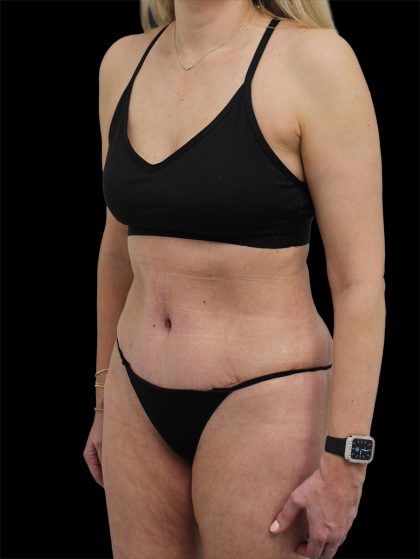 Tummy Tuck Before & After Patient #2694