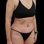 Tummy Tuck Before & After Patient #2694