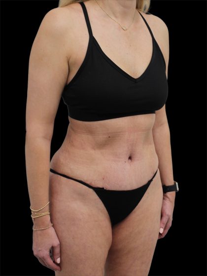 Tummy Tuck Before & After Patient #2694