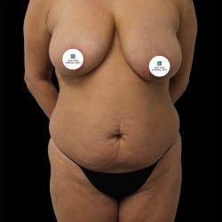Tummy Tuck Before & After Patient #2695
