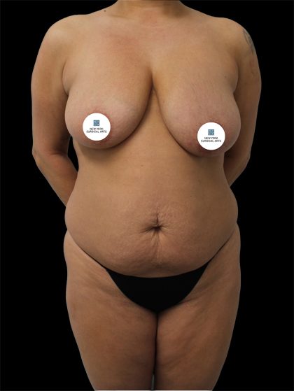 Tummy Tuck Before & After Patient #2695