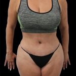 Tummy Tuck Before & After Patient #2695