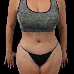Tummy Tuck Before & After Patient #2695