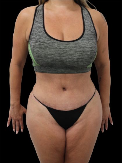 Tummy Tuck Before & After Patient #2695