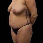 Tummy Tuck Before & After Patient #2695