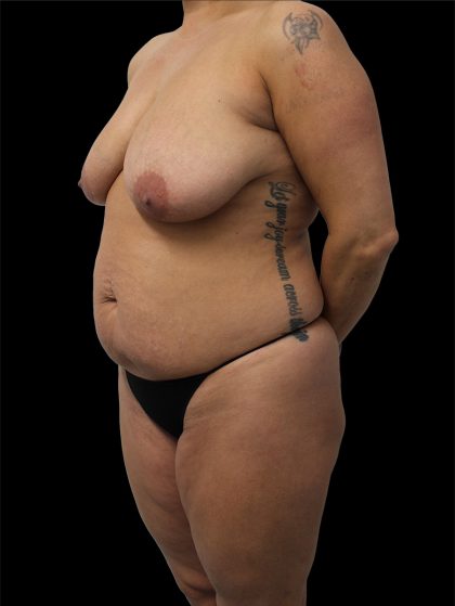 Tummy Tuck Before & After Patient #2695