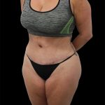 Tummy Tuck Before & After Patient #2695