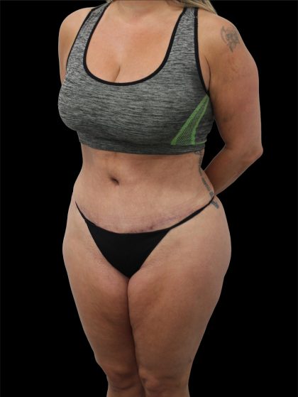 Tummy Tuck Before & After Patient #2695