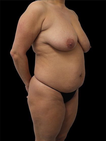 Tummy Tuck Before & After Patient #2695