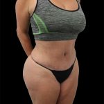 Tummy Tuck Before & After Patient #2695