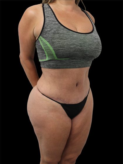Tummy Tuck Before & After Patient #2695